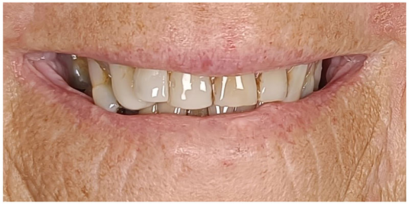 Smile Design Before