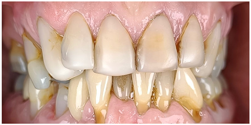 Smile Design Before