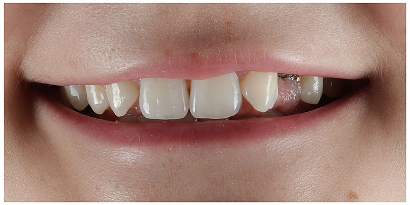 Smile Design Before