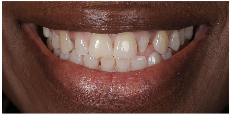 Smile Design Before