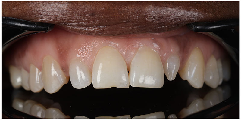 Smile Design Before