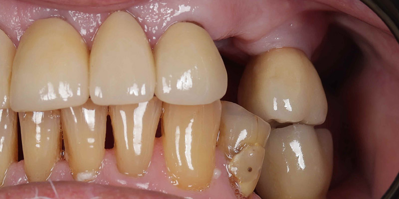 Implant Before