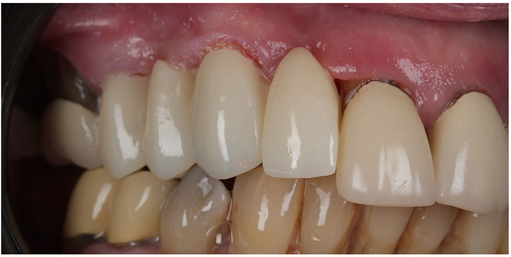 Bridges After