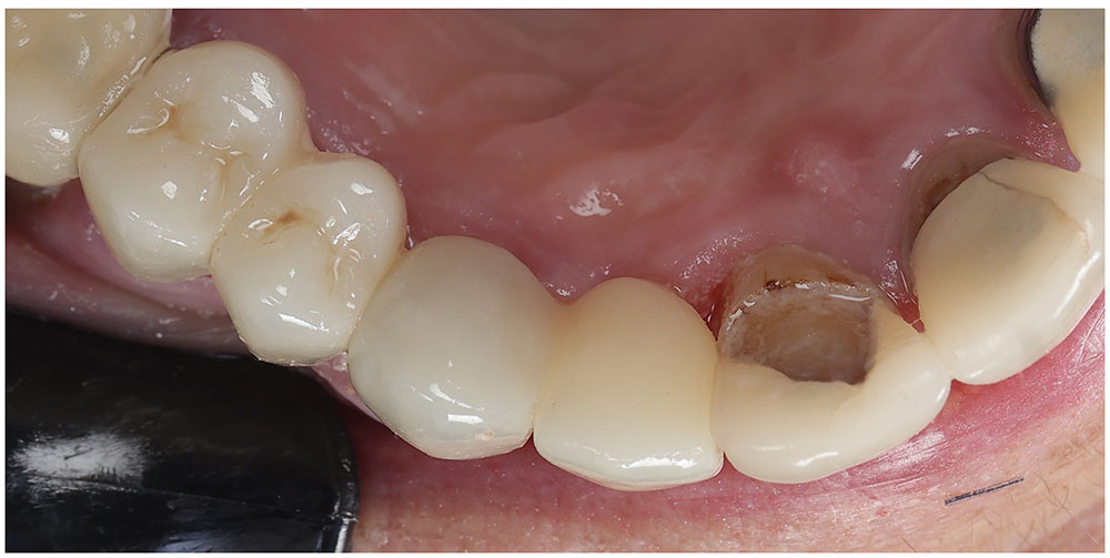 Bridges After